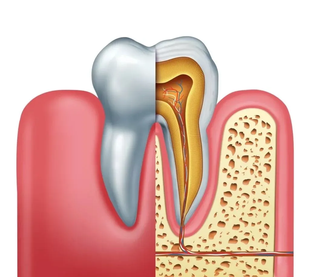 Diagram of root canal treatment inside a tooth