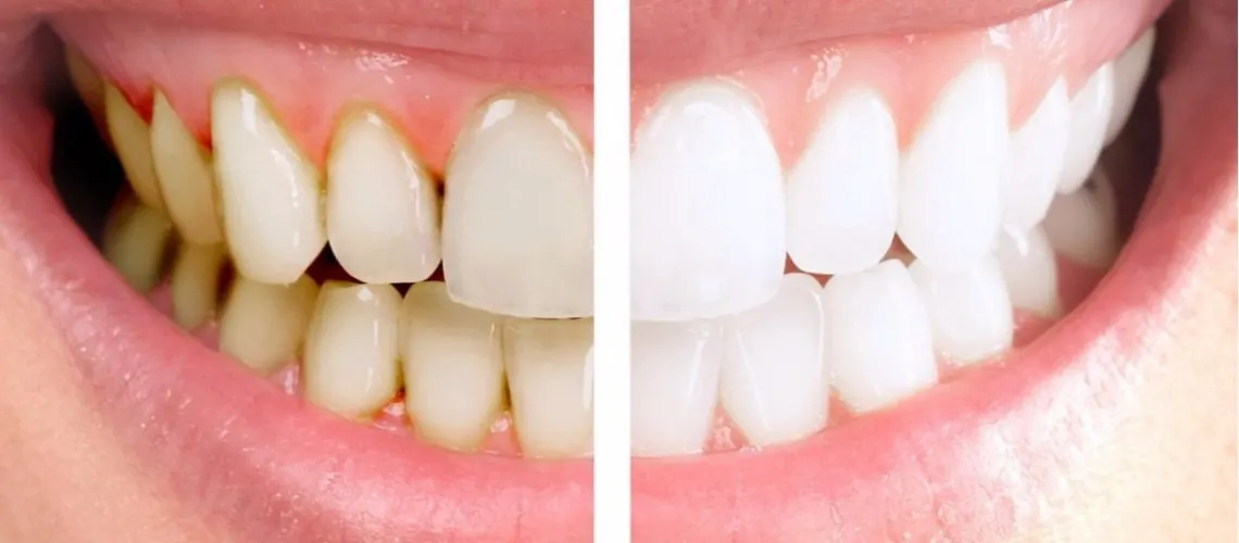 Close-up of healthy gums during a periodontal exam